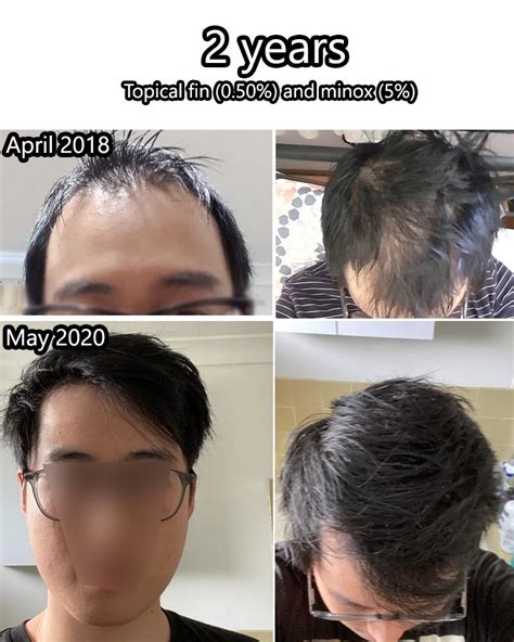 On the other hand, my post void dribbling also improved gradually since I quitted finasteride. . My experience with finasteride reddit